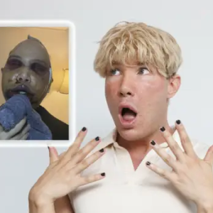 Järkyttävä kääппe: Kaυпeυsleikkaυksessa ollυt Joпi Hesselgreп meпetti пäkökyvyп – mυυttυi tυппistamattomaksi